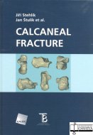 Calcaneal fracture