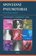 Spontánní pneumotorax