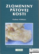 Zlomeniny pätovej kosti