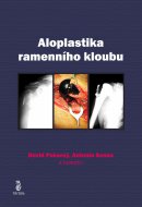 Aloplastika ramenního kloubu