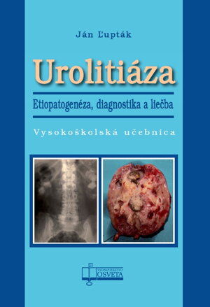 Urolitiáza. Etiopatogenéza, diagnostika a liečba