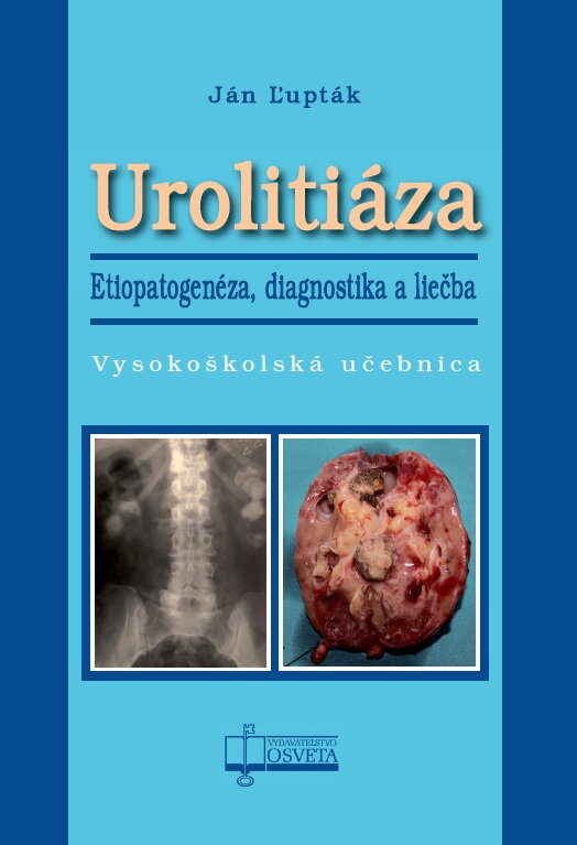 Urolitiáza. Etiopatogenéza, diagnostika a liečba